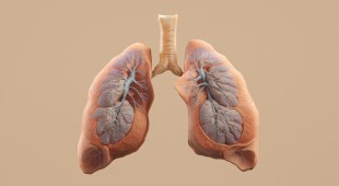 Drawing of a pair of lungs. Silicosis
